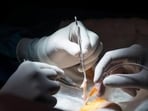 (FILES) In this file photo taken on February 28, 2017 Surgeon Mario Alvarez Maestro (R) and an assistant prepare a kidney for a renal transplantation on patient Juan Benito Druet at La Paz hospital in Madrid. A Frenchman recently became the first person to receive a second face transplant after the first failed, and another made history by regrowing skin lost over 95 of his body, thanks to a graft from his twin brother. Transplants are no longer limited to the vital organs: heart, liver, or lungs. Nowadays, people can get a new hand... even a uterus. But some organs remain off-limits. For now. / AFP PHOTO / PIERRE-PHILIPPE MARCOU (AFP)