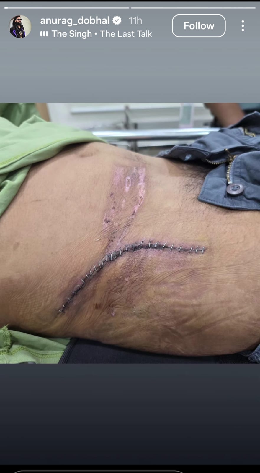 Anurag Dobhal shares picture of his injury after car crash. Anurag Dobhal shares picture of his injury after car crash.