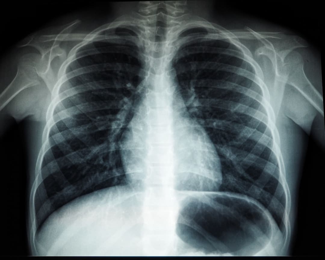 TB can also impact the brain, spine, lymph nodes, and other organs. (Unsplash) TB can also impact the brain, spine, lymph nodes, and other organs. (Unsplash)
