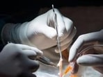 On March 23, the team performed an exploratory laparotomy, which revealed the tumour's origin in the uterus. On March 23, the team performed an exploratory laparotomy, which revealed the tumour's origin in the uterus.