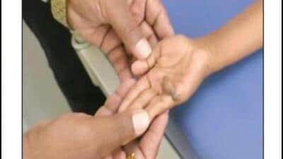 Probe panel set up after wrong-hand surgery on child at Pandharpur hospital Probe panel set up after wrong-hand surgery on child at Pandharpur hospital