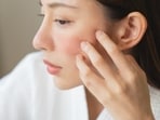 Ensure your skin is hydrated to prevent irritations and dryness in summer. (Shutterstock)