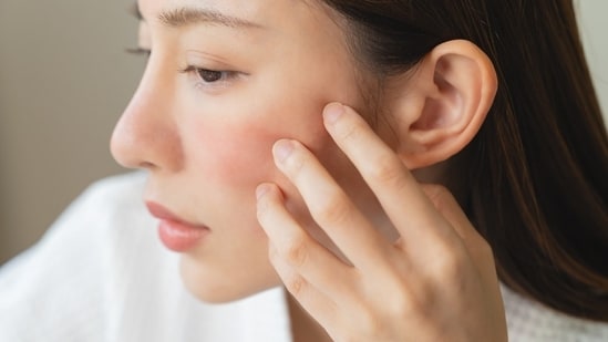 Ensure your skin is hydrated to prevent irritations and dryness in summer. (Shutterstock)