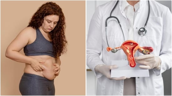 Dr Ritu Dave emphasises that obesity raises the risk of ovarian cancer through hormonal imbalance and chronic inflammation. (Freepik)