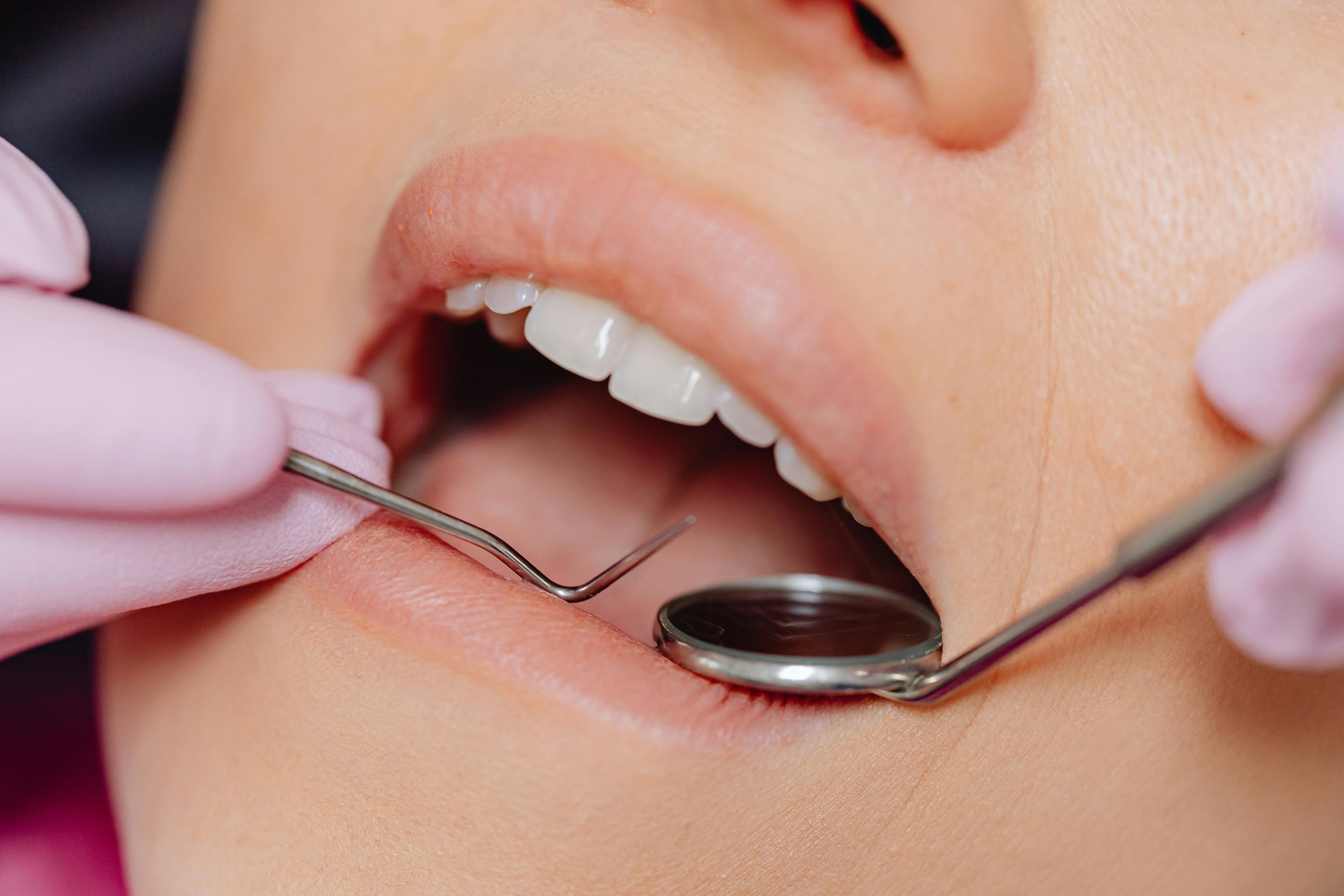 Bruxism is a condition where teeth clench or grind, is another common way that stress shows up. (Pexel) Bruxism is a condition where teeth clench or grind, is another common way that stress shows up. (Pexel)