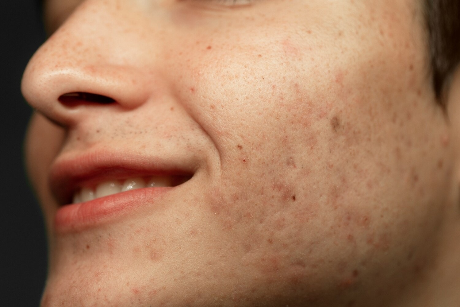 Food doesn’t cause pigmentation — heat, sun exposure and skin irritation matter more. Food doesn’t cause pigmentation — heat, sun exposure and skin irritation matter more.
