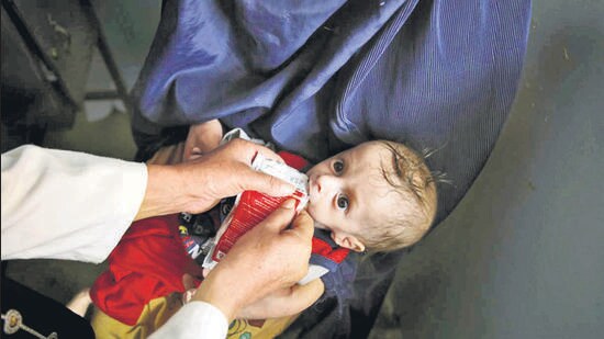 Child malnutrition cases fall from 80,000 to 13,000 in 3 years