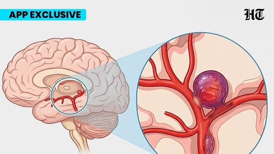 Read more to find out about brain aneurysms! (Image generated via Google Gemini)