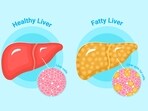 Fatty liver disease can progress to fibrosis and chronic liver failure if untreated. (Freepik)