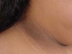 Dark patches on the skin are a sign of an underlying health issue, shares Dr Sheshadri. (Pinterest)
