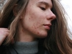 Hormonal acne could be a result of an unbalanced gut microbiome.(Unsplash)