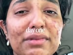 Sara, from Dubai, shared how she cleared up her acne.