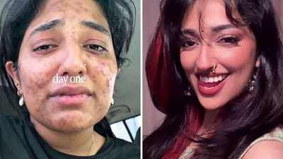 Sara, from Dubai, shared how she cleared up her acne. (Instagram/@sazzybaer) Sara, from Dubai, shared how she cleared up her acne. (Instagram/@sazzybaer)
