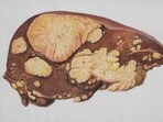 Early signs of fatty liver.(Pexel)
