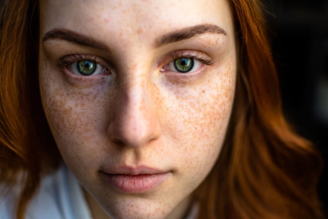 Darkening of skin is one of the subtle signs of vitamin B12 deficieny. (Pexel) Darkening of skin is one of the subtle signs of vitamin B12 deficieny. (Pexel)