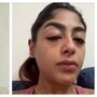 క్లబ్‌లో గొడవ, రియాలిటీ షో నటిపై ఘోరంగా దాడి- విరిగిన పన్ను, కమిలిపోయిన మొహం- వణికిపోతూ ప్రీత్ సింగ్ ఆవేదన!


