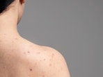 Body acne is common in the summer season. (Picture credit: Freepik)