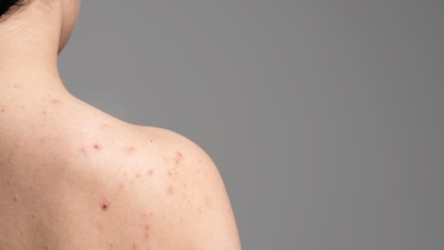 Body acne is common in the summer season. (Picture credit: Freepik) Body acne is common in the summer season. (Picture credit: Freepik)