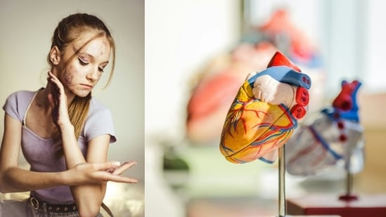 Skin changes that indicates heart disease. (Unsplash)