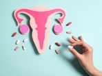 Dr Kapasi notes that, in India, most women are diagnosed with ovarian cancer only after the disease has already spread.  