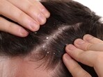 Dandruff appears as flaky white dust.(Shutterstock)