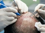 The man from Lahore went to a Srinagar clinic for the procedure.