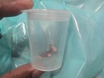 The foreign body removed from the airway of the child (HT Photo)