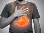 Foods to avoid for heartburn relief: Tips from a gastroenterologist.