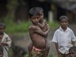 Malnutrition 