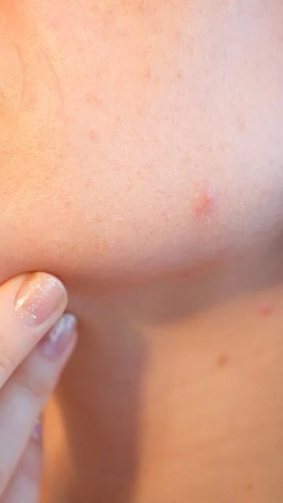 Experts explain the hidden link between blood sugar spikes, acne and hormonal health. (Pixabay)