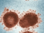 The 'vomit bug,' or norovirus, is causing outbreaks across the US, especially in California. Symptoms arise within 12 to 48 hours and may lead to dehydration.