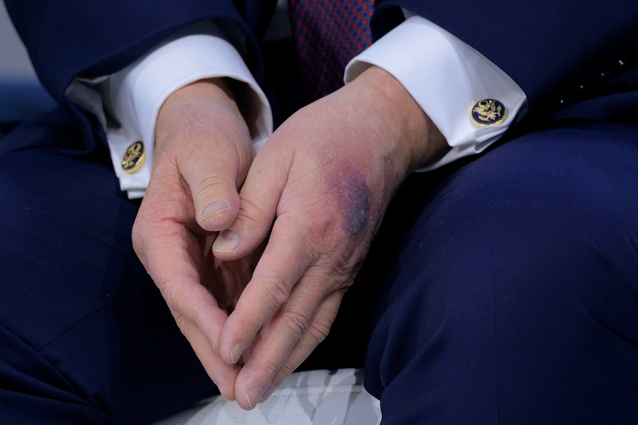 The physical report mentions that bruising occurs on Trump’s hands. The physical report mentions that bruising occurs on Trump’s hands.