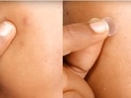 Pimple and acne patches to treat your pimple marks Pimple and acne patches to treat your pimple marks