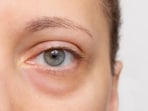 In the summer season, the under-eye area becomes puffier! In the summer season, the under-eye area becomes puffier!