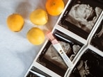 Why egg freezing is on the rise among women in their 30s.