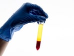 A 65-year-old man noticed his urine was discoloured — an alarming sign that could indicate kidney issues. (Freepik)