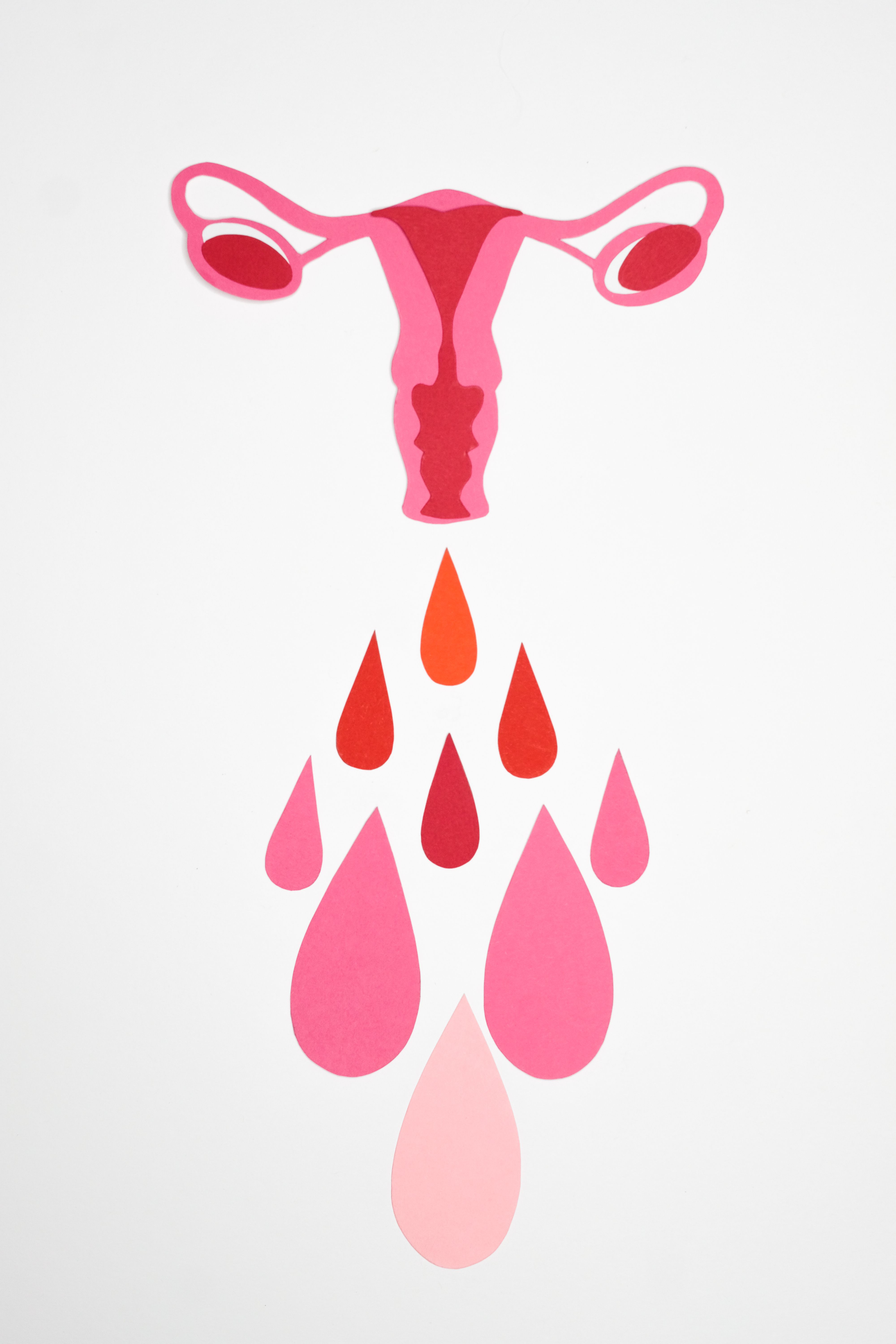 Excessive menstrual blood loss can worsen the condition. (Pexel) Excessive menstrual blood loss can worsen the condition. (Pexel)