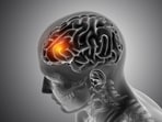 When a headache is more than ‘just stress'.