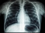  TB prevalence was unusually high in Vidarbha's cotton-growing belt or tribal-dominated regions compared to other parts of Maharashtra