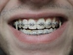 Dental braces work in adults as well, shares Dr Parekh. 
