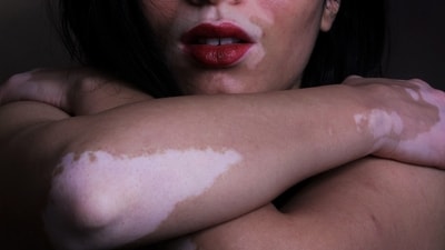 What really causes new white patches to appear in vitiligo. (Unsplash) What really causes new white patches to appear in vitiligo. (Unsplash)