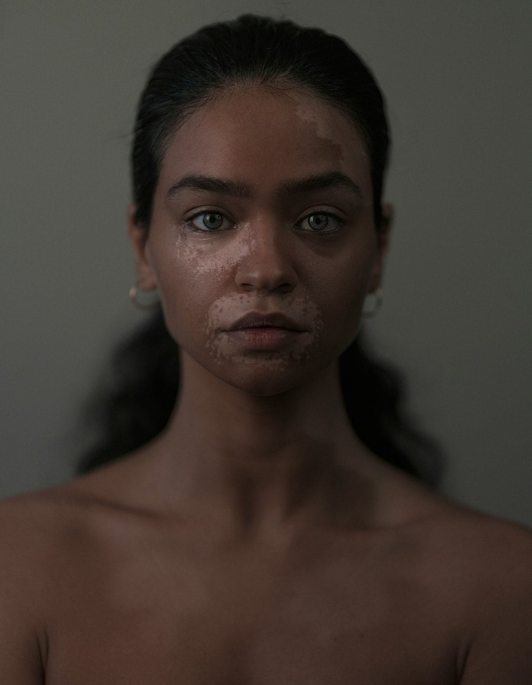 All white patches are not vitiligo. (Unsplash) All white patches are not vitiligo. (Unsplash)