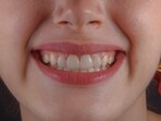 Viral teeth whitening hacks that works.