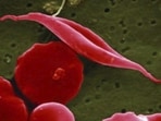 Sickle cell disease (AP)