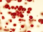 Sickle cell anaemia(Freepik)