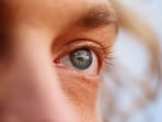 Cataract leads to gradual loss of vision in the eye. 