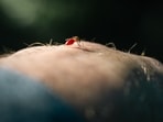 Getting diagnosed early for malaria helps one avoid later complications.