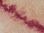The CDC reports 145 cyclosporiasis cases across 17 states as of June 16, with 20 hospitalizations and no fatalities. The outbreak reflects a seasonal increase, particularly in Michigan, which has seen over 170 cases since June 22.(Pixabay)