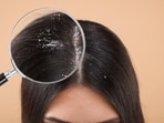 Check out doctors' tips for managing dandruff during the monsoon season.
