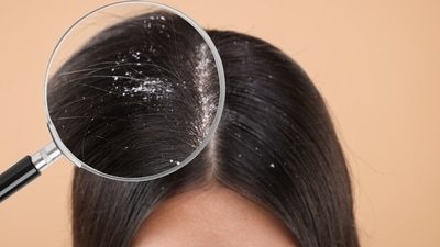 Check out doctors' tips for managing dandruff during the monsoon season. (Shutterstock) Check out doctors' tips for managing dandruff during the monsoon season. (Shutterstock)